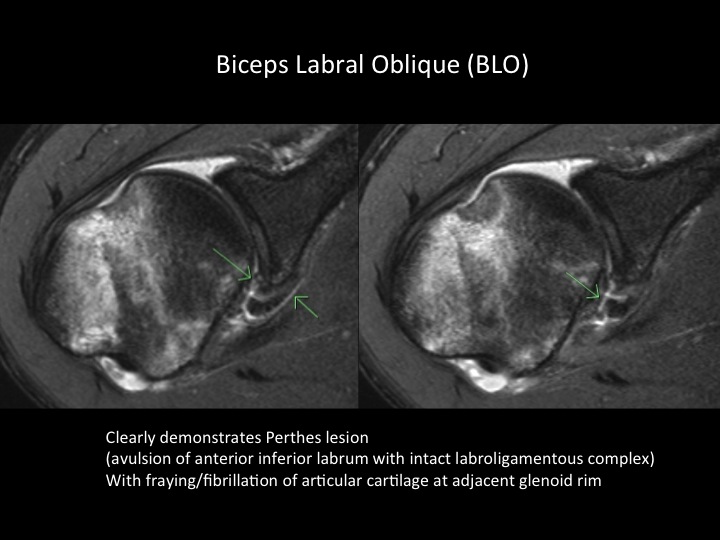 Figure 2 for case Perthes lesion